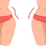 Quels types de procédures chirurgicales sont disponibles pour corriger les hip dips