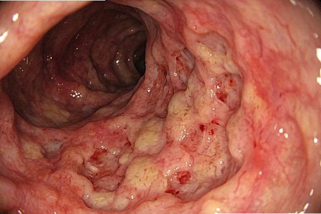 maladie de Crohn